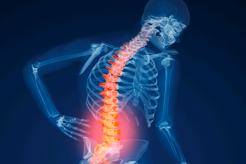 A osteoporose é uma doença silenciosa e que não apresenta sintomas.